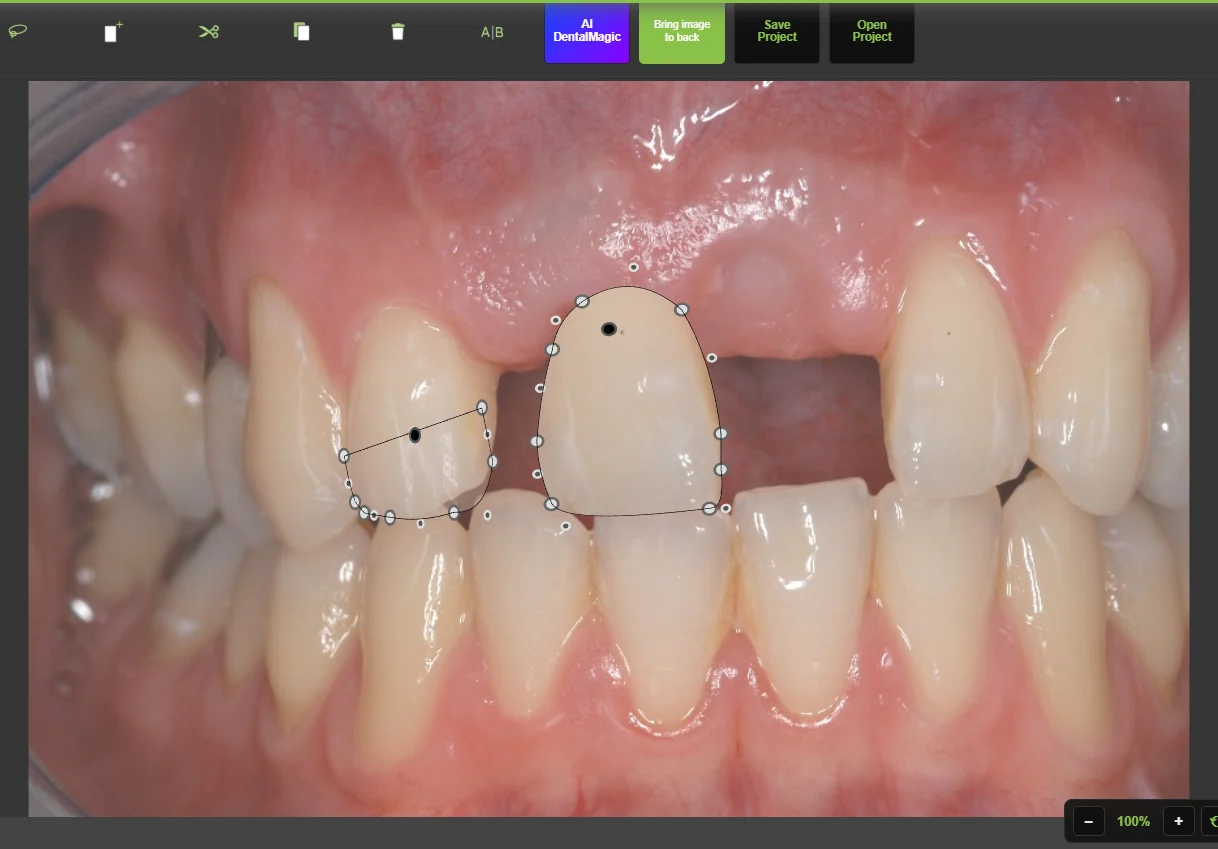 An intraoral photograph in the DentalMagic workspace with an edentulous space between two incisors. A neighbouring tooth has been outlined with the lasso and turned into a layer, and a copy of it has been placed in the gap — both layers showing their white control points and their black anchor dot.